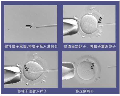 龙凤胎代怀_宝贝计划代生宝宝网,为什么医*不建议直接做二代试管